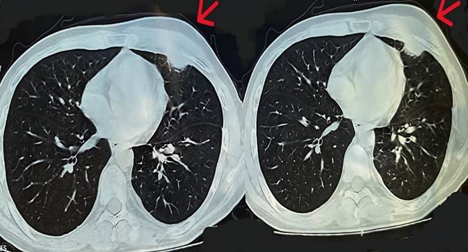 Pulmonary Nocardiosis with Cutaneous Involvement: A Diagnostic Conundrum