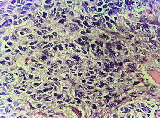 Extracranial Metastases of Glioblastoma to Parotid Gland: A rare Case Report