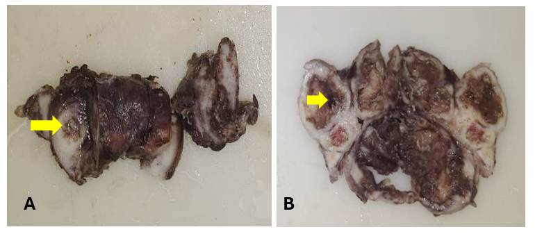 Xanthogranulomatous SalpingoOophoritis with Ovarian Osseous Metaplasia Mimicking a Complex Adnexal Cyst in a Nulliparous Women: A Rare Diagnostic Conundrum