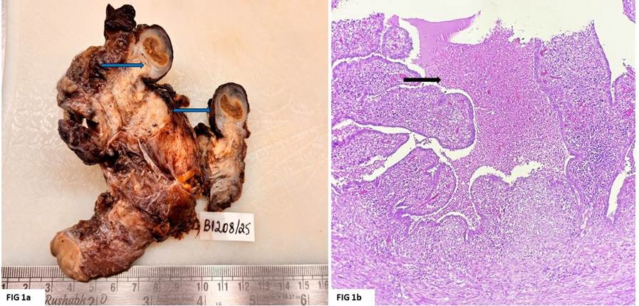 When the Tube Speaks First: Pseudoxanthomatous Salpingitis Providing a Clue to Underlying Endometriosis