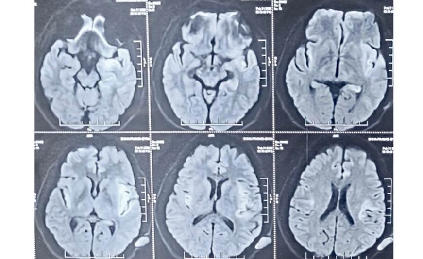 Mollaret Cells: A Rare but Notable Finding in Cerebrospinal Fluid