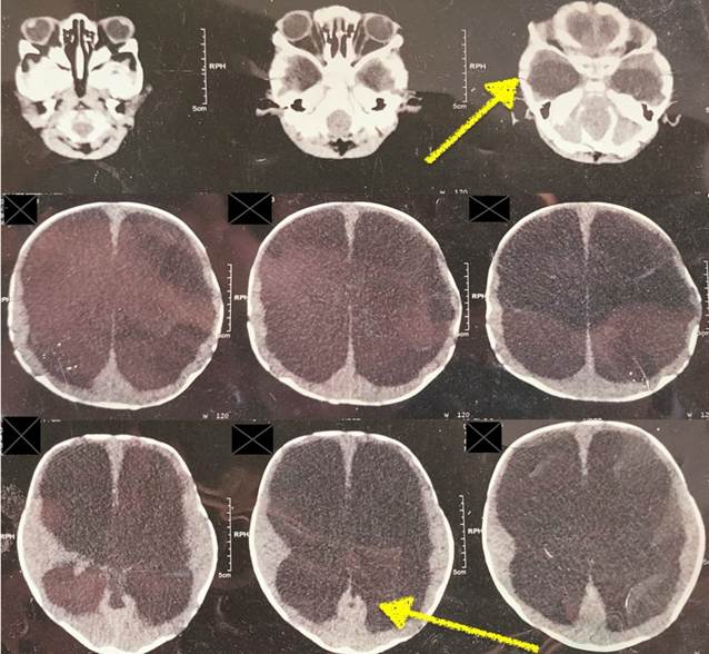 Premature Twin Delivery Complicated by Congenital Hydrocephalus and Severe Malnutrition in a Rural Setting: A Syndemic Case Report