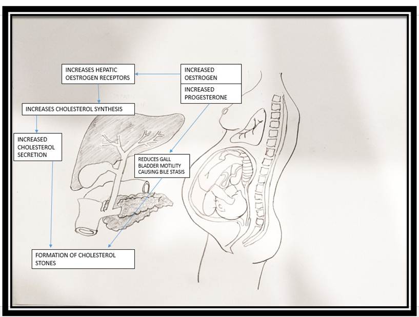 Biliary Disease in Pregnancy: Implications for Anaesthesia Management