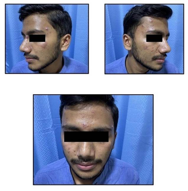 Prevalence of Metabolic Syndrome and Insulin Resistance in Post Adolescent Male Patients with Acne
