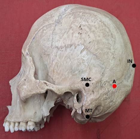 Localization of Asterion - An Anatomical Revisit with Clinical Implication