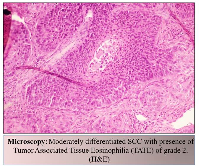 Tumor Associated Tissue Eosinophilia (TATE) in Oral Squamous Cell Carcinoma: A Histological Biomarker with Grade Dependant Signicance