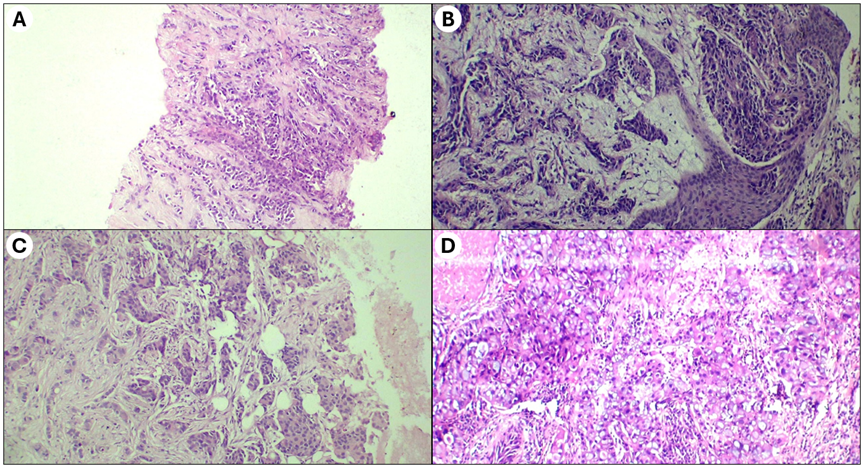 Assessment of Tumor Inltrating Lymphocyte Scoring in Breast Cancer and its Correlation with Other Prognostic Markers