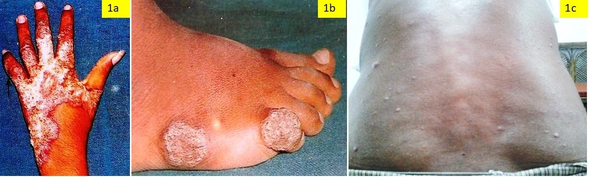 Clinico-Histological Prole of Cutaneous Granulomas in a Tertiary Care Hospital