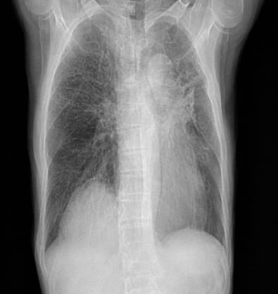 A Case Report on Unexpected Intralobar Pulmonary Sequestration in an Elderly Male: Imaging-Based Diagnostic Insight