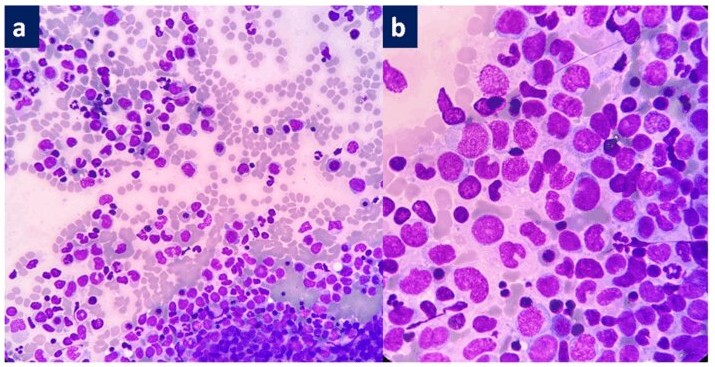 Childhood Acute Myeloid Leukemia with a Rare Translocation t(3;5)