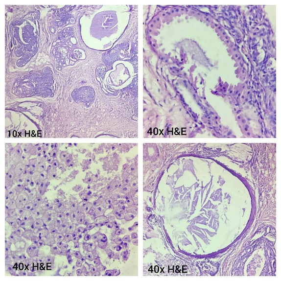 Uncommon but Signicant: A Case of Juvenile Papillomatosis with Literature Review