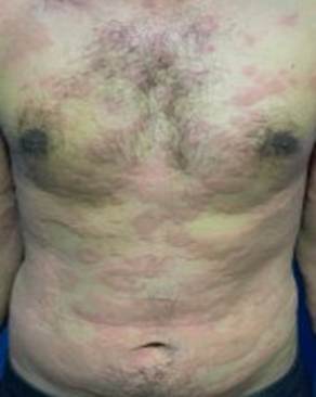 Metabolic Syndrome and Biomarkers in Chronic Spontaneous Urticaria: A CrossSectional Study in a Tertiary Care Hospital
