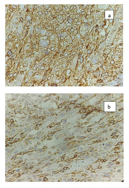 Pleomorphic Giant Cell Carcinoma of the Prostate: A Rare Case Report