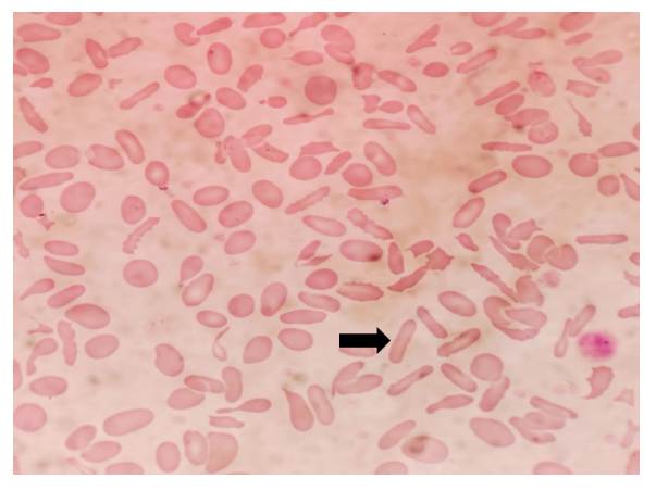 Peripheral Smear to Pedigree: A Familial Case of Hereditary Elliptocytosis –A Rare Case Report