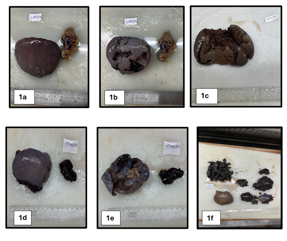 Pathological Insights into Ruptured Spleen: A Histomorphological Approach