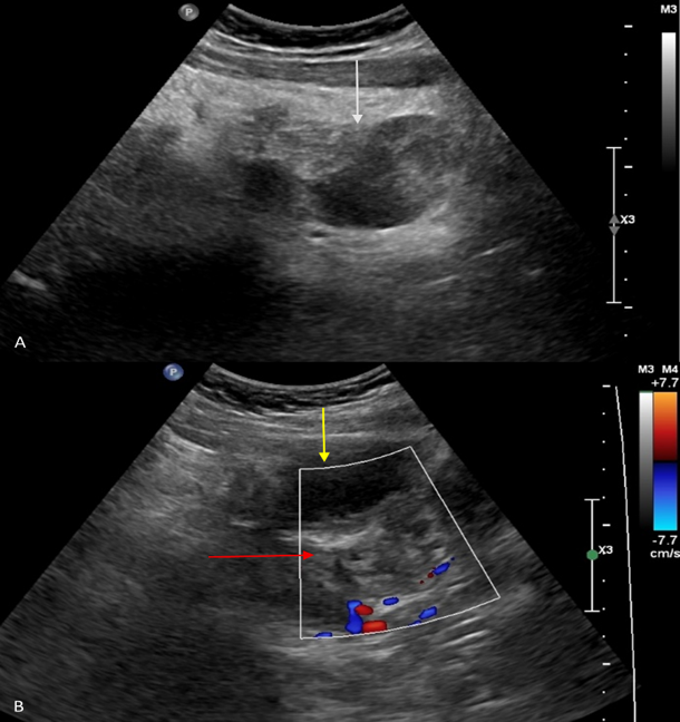 Auto-Amputated Ovarian Dermoid Cyst Following Delayed Presentation of Ovarian Torsion: A Case Report